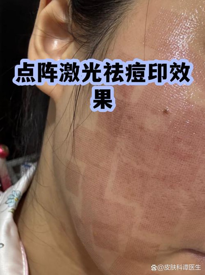 太原专业祛痘：让肌肤焕发自然光彩