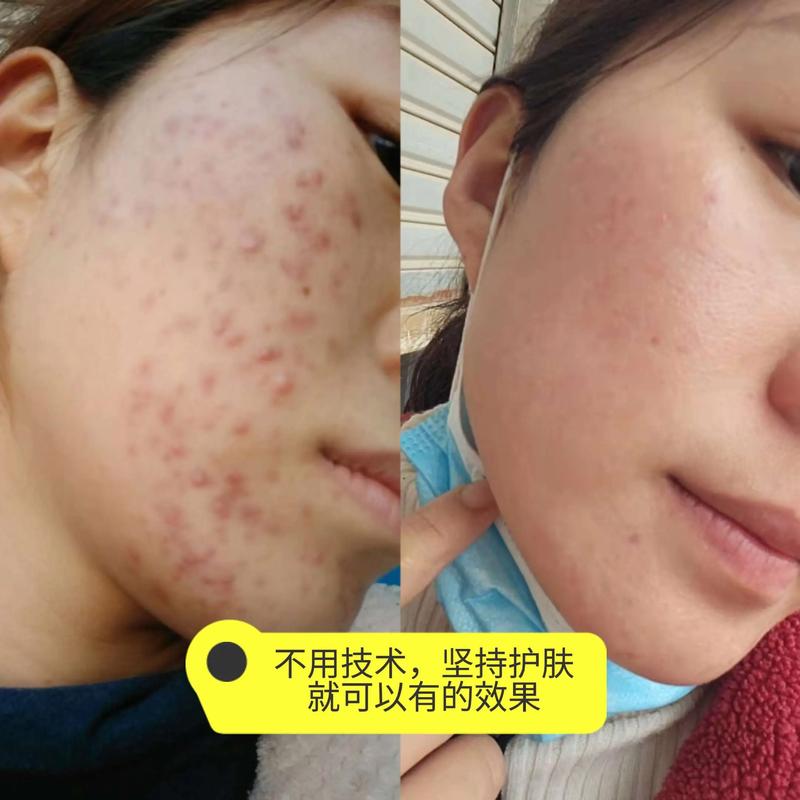 太原祛痘去哪里最好？带你了解当前行业动态！