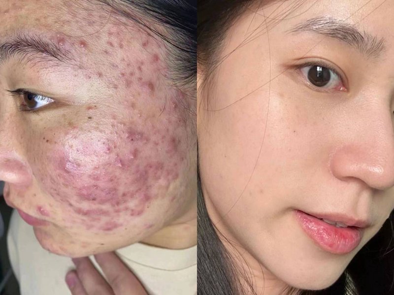 太原专业祛痘——青春与健康的对话