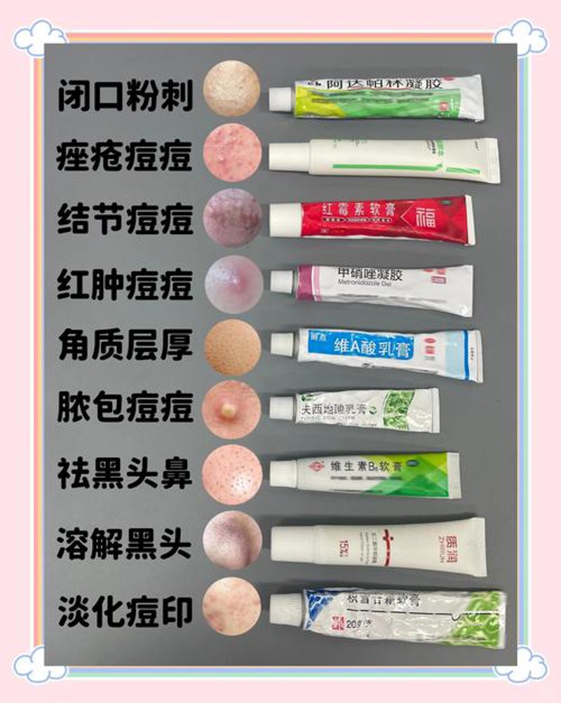 太原祛痘攻略：告别青春痘困扰